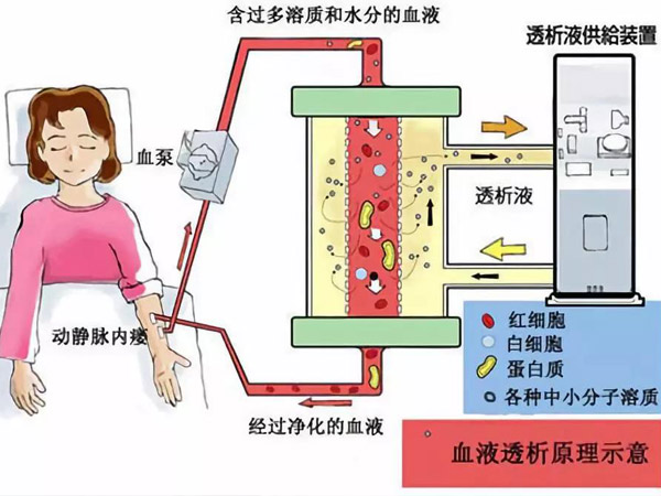 新容奇医院开展腹膜透析，让尿毒症患者拥有更多选择